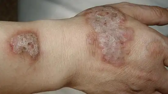 身上长湿疹皮肤瘙痒会传染给别人吗?曝光,告别谣言困扰!_患者_问题_风