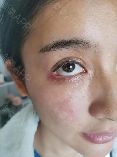 客服一直说疤痕会好转 可是还是一点起色也没有 眼角天天都红红的