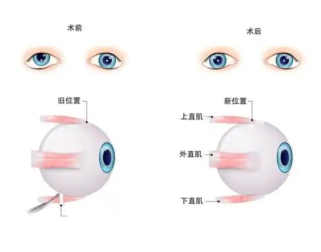 如果是重度斜视就需要进行手术了,一般术后还需要做一些视功能方面的
