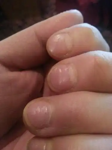 我的手指甲出现了明显的横凹纹,请问是什么情况?