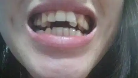 今年二十五岁,但是牙齿歪到不行,并且有恶化趋势,有图,请专业牙齿医生