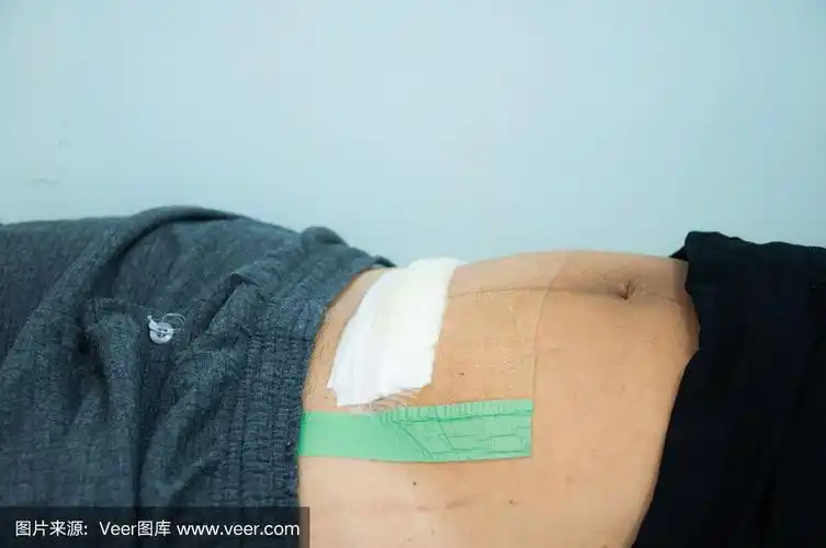 剖宫产创面纱布包扎.腹部