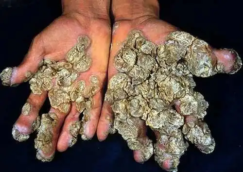 【病因】寻常疣的病因:由病毒感染引起