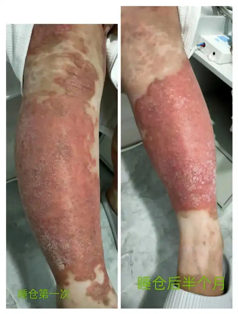 皮肤病太可怕了