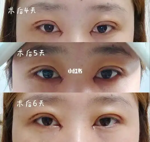 全切双眼皮手术恢复过程_双眼皮手术_全切双眼皮_美妆_医美整形