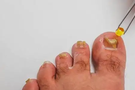 足脚细菌感染图片