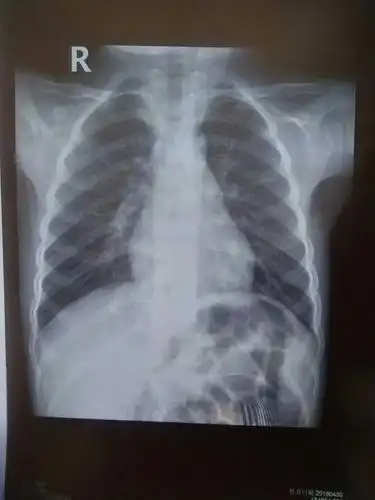 咳嗽到诊断肺炎,没让孩子输液(持续记录)