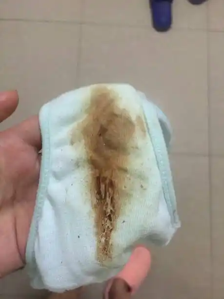 喝了调理姨妈中药后这是月经还是白带呀