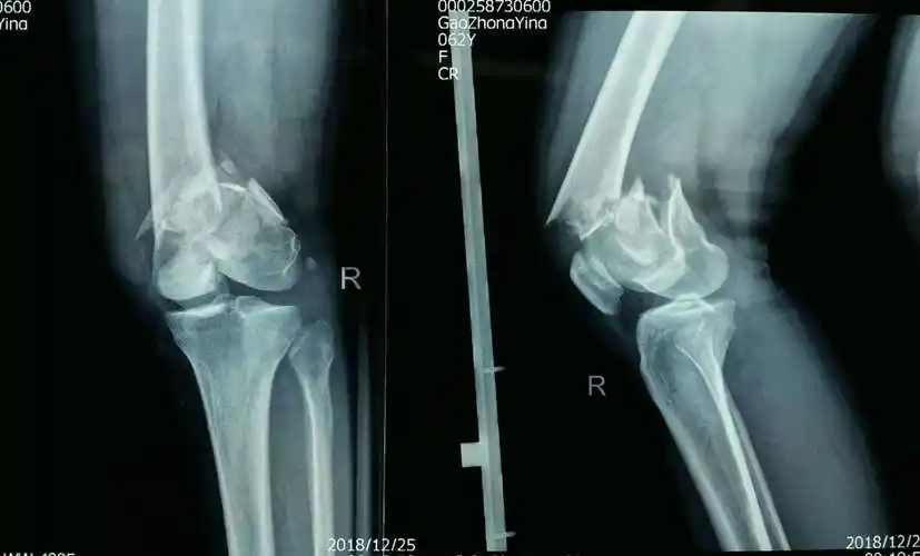 股骨髁上骨折