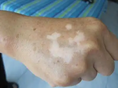 境界模糊,隐约可见,与正常皮肤不易区分,易被误诊为白色糠疹或汗斑等