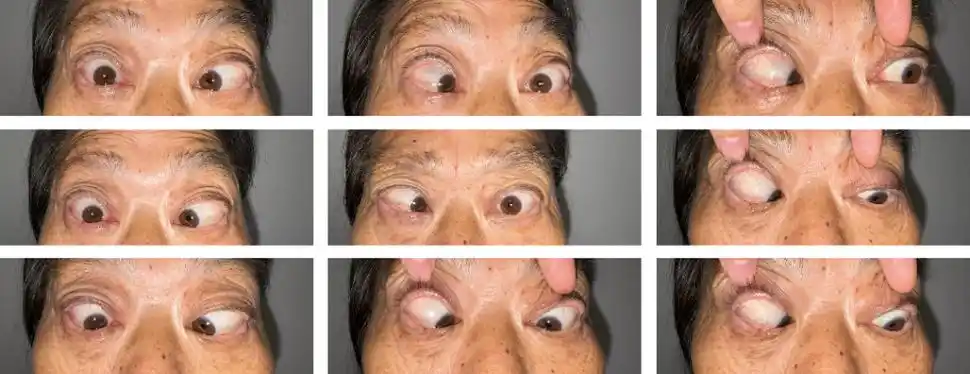 宣汉县人民医院眼科成功为超高度近视伴固定性斜视的患者实施手术