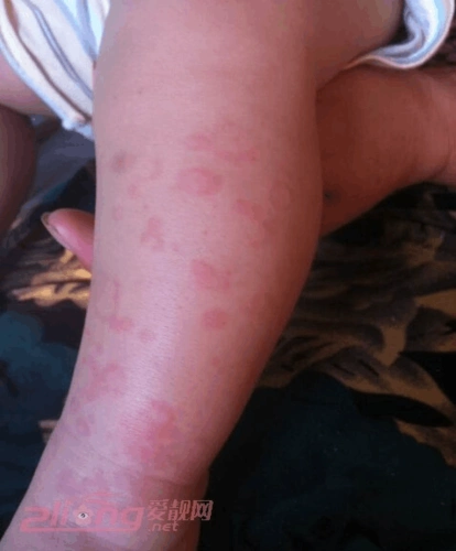 婴儿汗斑图片 婴儿汗斑治疗方法有哪些