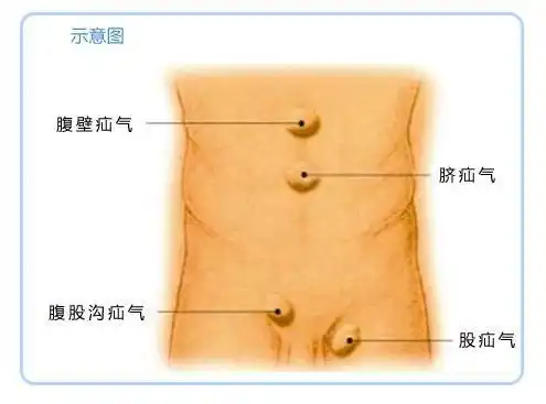 哪些人是疝气的高危人群?手术治疗会复发吗