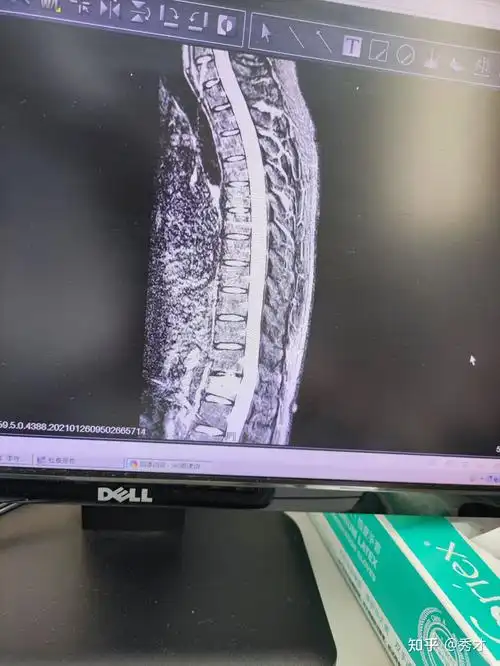 病例分享胸12椎体压缩性骨折