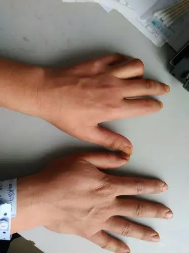 左侧骨间肌萎缩