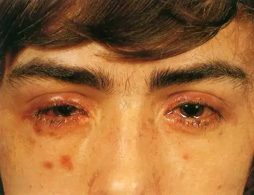 发几张糖尿病眼病的图片!