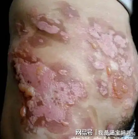 "比新冠还可怕的病"多地男性艾滋病疫情增长迅速!