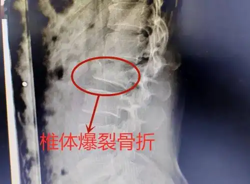 双下肢失去知觉腰椎爆裂性骨折疼痛 出血