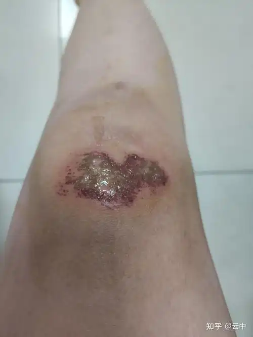 电动车撞人了,造成对方皮外伤.现在找我要2000元. - 知乎