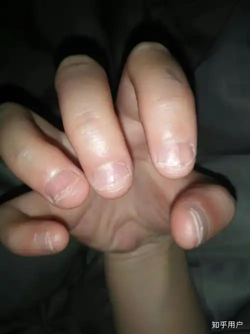 咬手指甲到底是心理问题还是生理问题? - 知乎