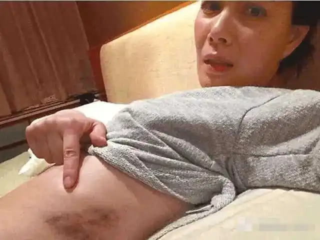 老公时常打骂她,腰部还有老公打骂留下的淤青!