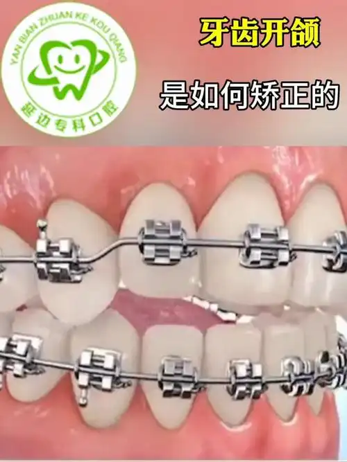 延吉牙齿矫正医院,对牙齿是如何矫正的?