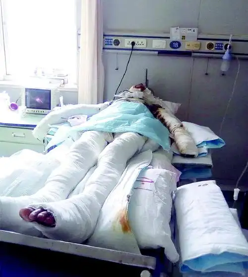 王质全身裹满绷带躺在病床.