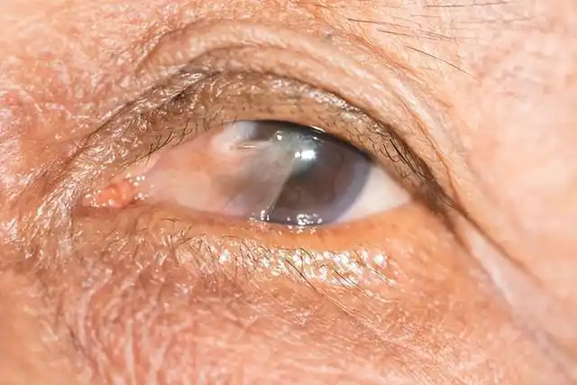 眼睛模糊,是不是意味着白内障?哪些变化,提醒你及时看下眼科