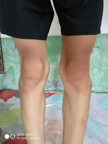 展开全部 o型腿,腓骨头凸出很严重,这样的照片双腿不受力,评估有误差