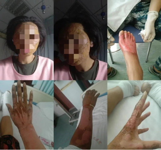 房车爆燃之后:昔日模特面部烧伤 7年翻12倍的市场"野蛮生长"