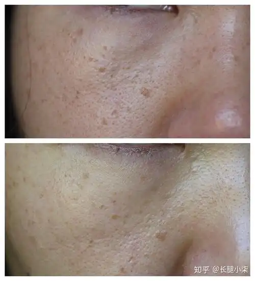 扁平疣记录 - 知乎