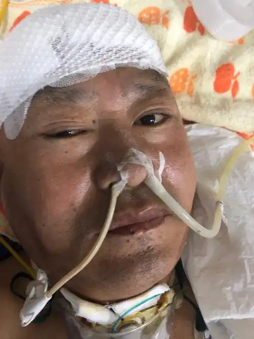 脑梗死溶栓后出血,双侧瞳孔散大,呼吸衰竭,系列救治措施,病人命不该绝