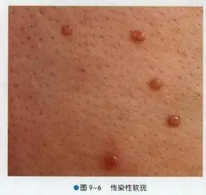 尖锐湿疣早期症状