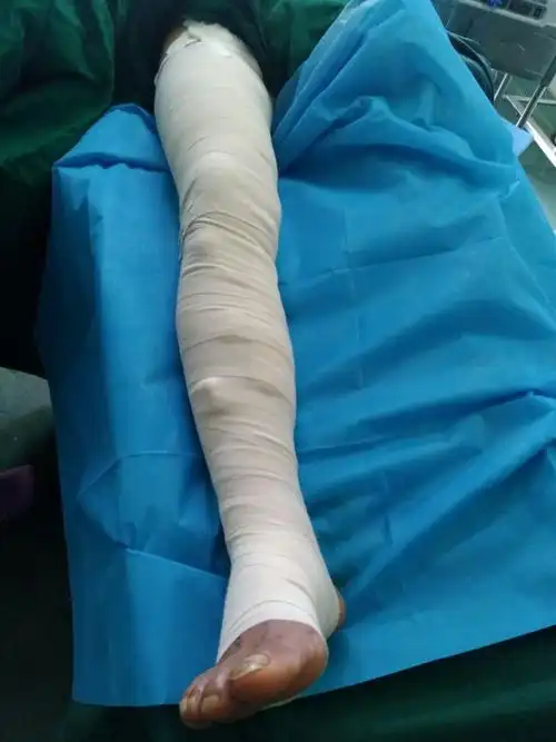 术后弹力绷带加压包扎