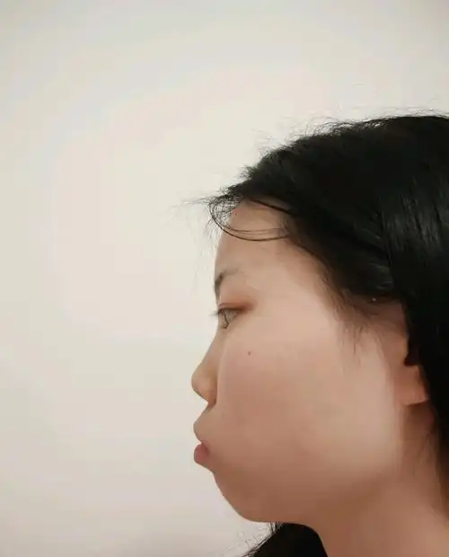 侧脸真的丑哭了牙齿矫正能治么