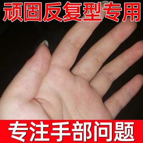 苗癣王汗斑癣专用药苗方皮老道手气止痒脱皮杀菌治疗皮癣苗医药膏