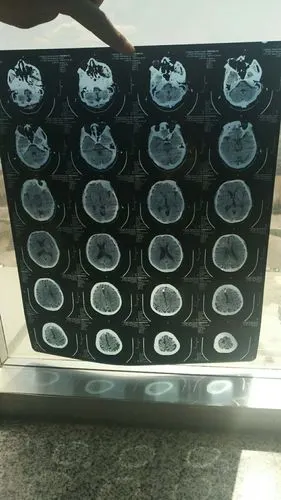 脑血栓溶栓治疗后,面积增大(附带片子)