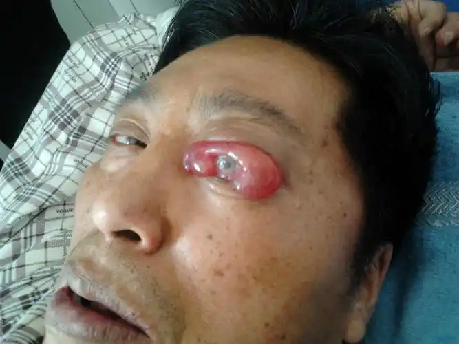 病人做腰椎手术,医生却把眼睛弄瞎!