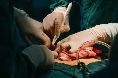 普通外科腹部手术 医院