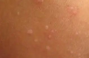 丝状疣初期图片