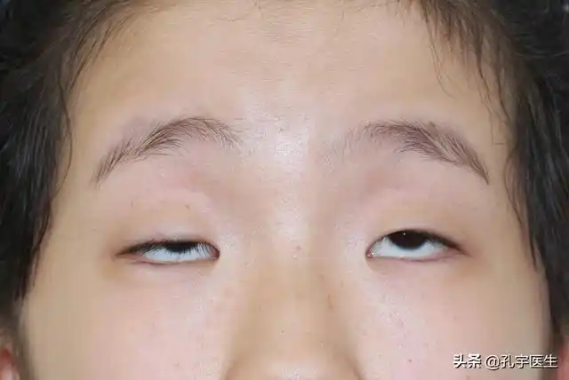 点击此处添加图片说明文字科学的治疗小眼睛问题,目前靠谱的还是手术