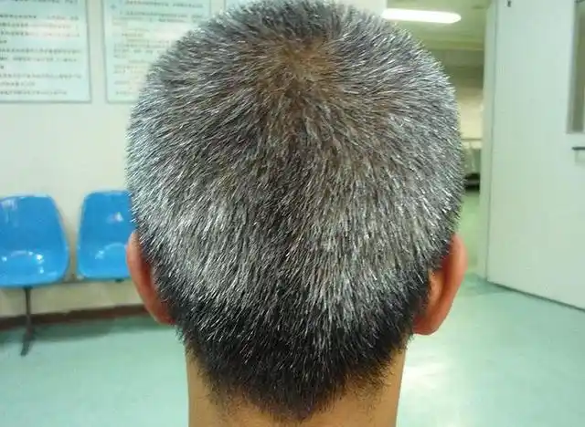 白头发越长越多不是老了或是身体缺了2种营养赶快看一下