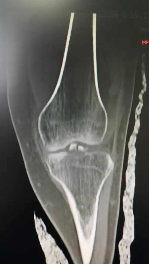 胫骨平台髁间脊骨折病例201811 - 好大夫在线