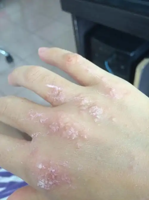 怀孕5个月,手脚长了很多汗疱疹怎么办