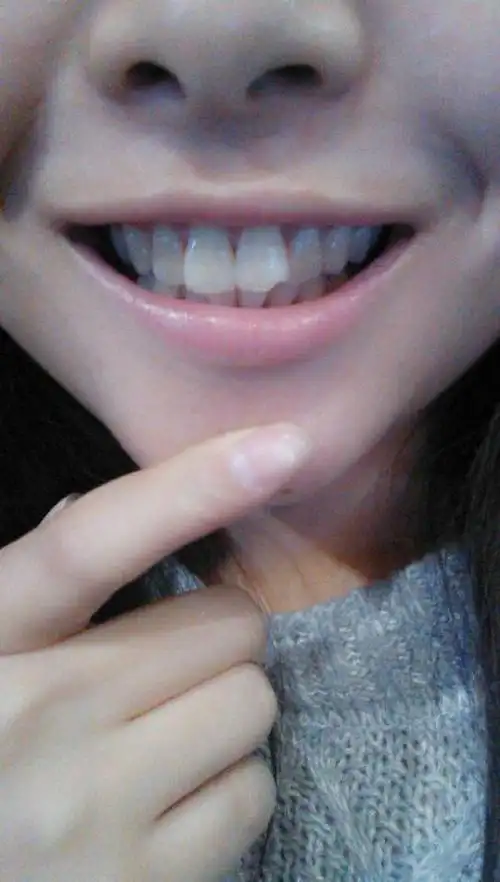 这是兔子牙吗,不会长成龅牙吧,这几天天天注意力