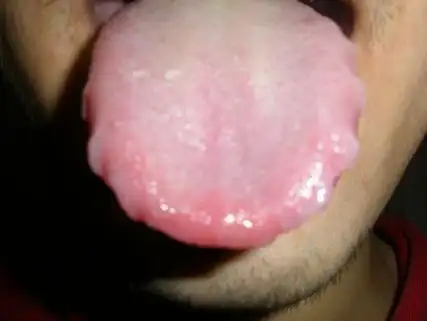 舌有齿痕一定是脾虚吗?