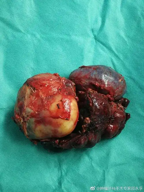 这是邵永孚去海南为病人切除的部份恶性肿瘤,如有不适望不要观看.