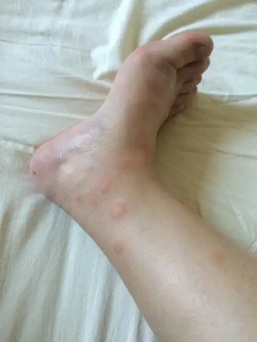 怀孕二十五周脚上被跳蚤咬了对胎儿有没有什么危害