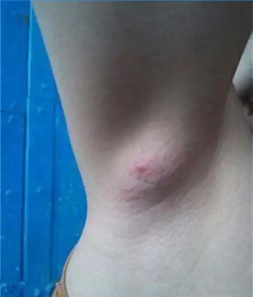 医生告诉王女士,她腋下长的是粉瘤,是由于皮脂腺排泄管阻塞,皮脂腺囊