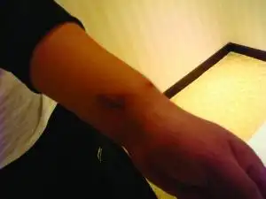 于有成向记者展示枪伤.他的手腕被子弹洞穿.